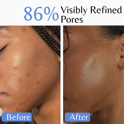 Before and after comparison showing visibly refined pores and smoother-looking skin after using Emilia Lux Purifying Mousse.